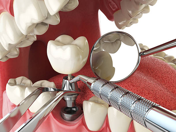 Best Emergency Dentist for Lost Fillings or Crowns in Potomac Mills, VA